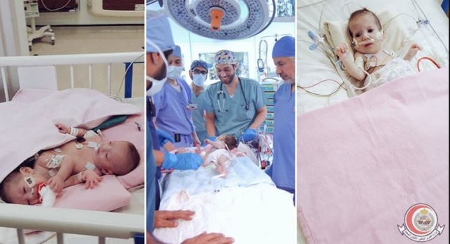 بالصور/ من فلسطين إلى السعودية...بعد عملية جراحية معقدة لفصلهما...وضع "حنين" مستقر و"فرح" في حالة موت سريري!