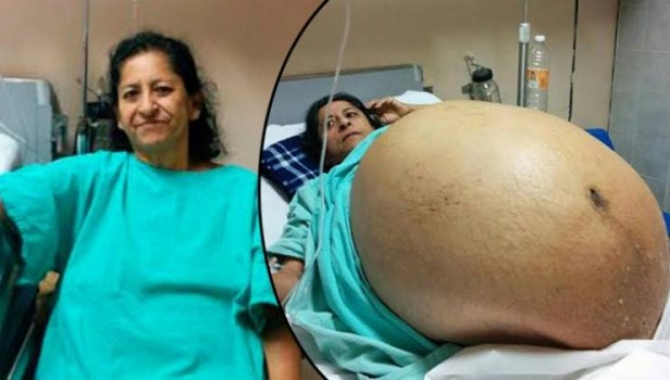 صور: ظل بطنها ينتفخ مدة 5 سنوات.. وذهل الأطباء عندما اكتشفوا ما بداخله!