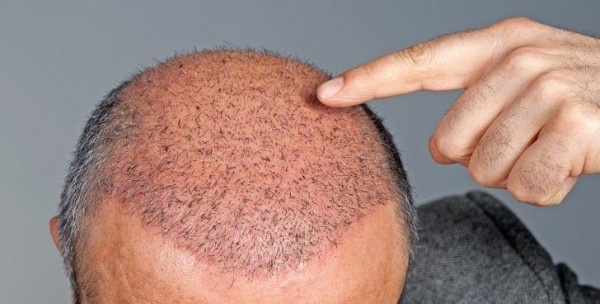 الإفتاء المصرية تضع شروطاً لعملية زراعة الشعر