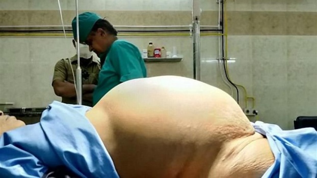 بالصور – استأصلوا من مبيضها ورماً يزن 11.8 كيلوغراما!