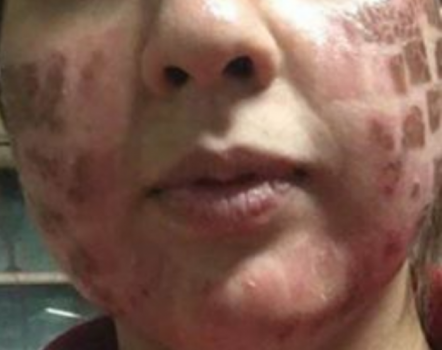 ذهبت لمركز تجميل استعداداً لزفافها.. فخرجت مشوهة وبعاهة مستديمة!