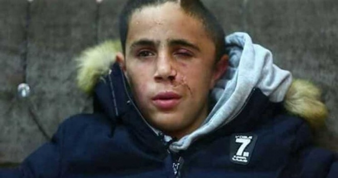 الصحافة الأجنبية تكشف كذب المنسق! طفل بنصف جمجمة.. الاحتلال يعتقل الطفل التميمي وينتزع منه "اعترافا" كاذباً