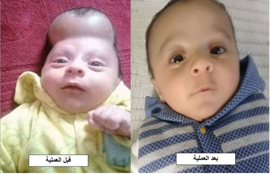 بالصور..عملية جراحية نوعية لترميم الأغشية الدماغية لطفل فلسطيني