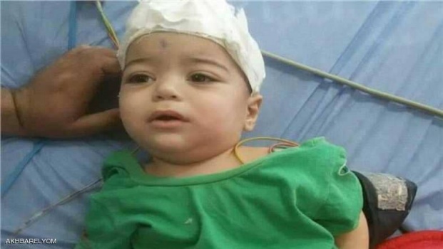 مصر.. "معجزة طبية" تنقذ رضيعا من سيخ حديدي اخترق رأسه