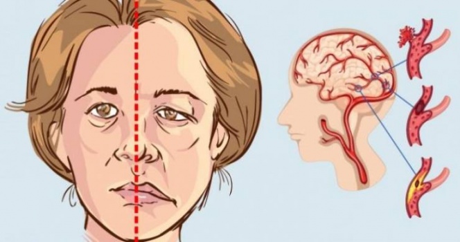 هكذا تتجنب خطر السكتة الدماغية
