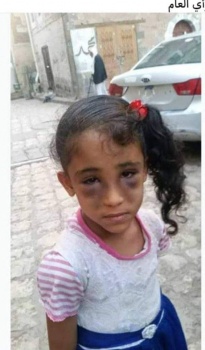 "شيماء" طفلة يمنية عذبها والدها بوحشية