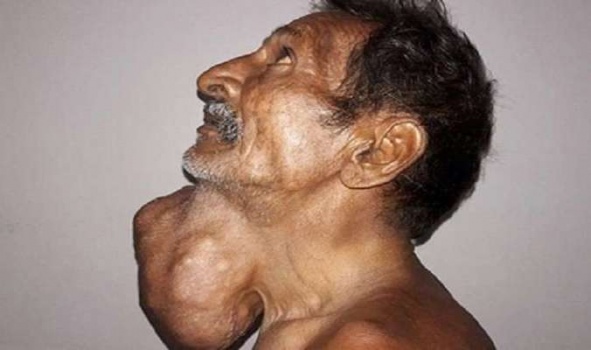 أهمل مراجعة الطبيب 20 عاما فحصل على ورم بحجم رأسه