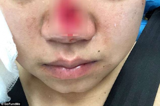 بالصورة- قضمت جزءاً من أنف سيدة أخرى... لماذا دار الشجار بينهما؟