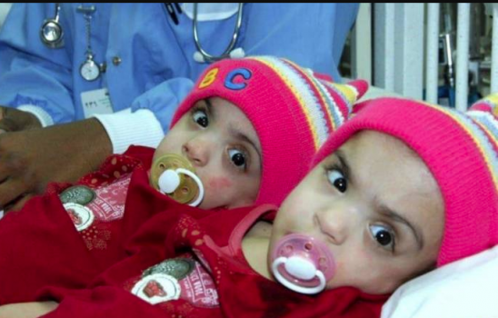 هل تذكرون التوأم الخليجي الملتصق صفاء ومروة.. هكذا أصبحتا بعد 11 عاماً