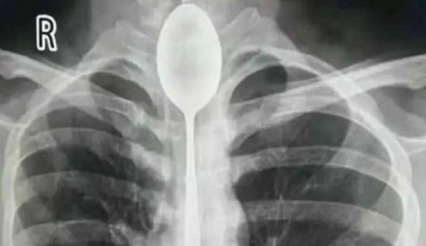 صيني ابتلع ملعقة وحدث ما لا يمكن تصوره