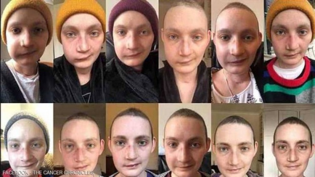 ناجية توثق رحلة شفائها من السرطان.. صور قبل وبعد بناء الوجه