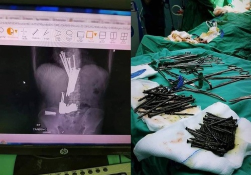 اطباء في مستشفى جنين الحكومي يستخرجون كمية كبيرة من المسامير من معدة مريض