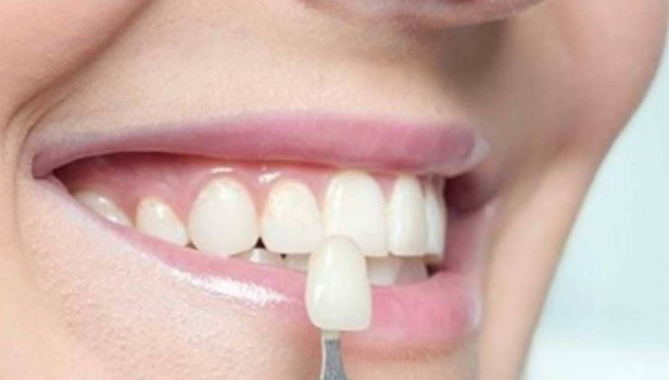 عدسات الأسنان اللاصقة.. حل تجميلي بتكلفة باهظة