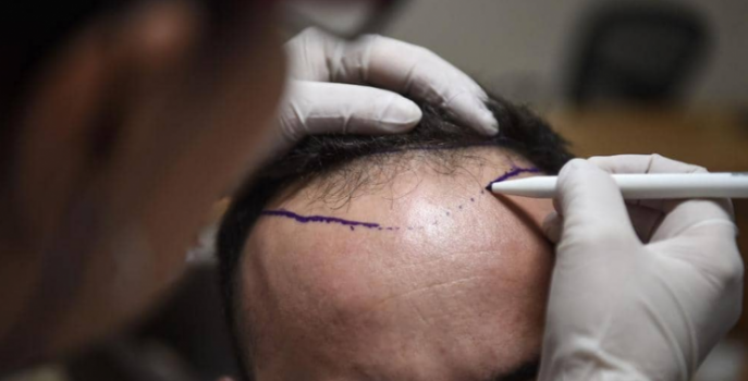 وفاة شخص في عملية زراعة شعر تحير الأطباء