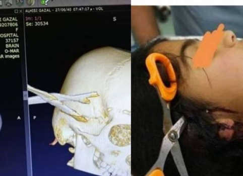 أطباء يستخرجون "مقصًا" من رأس طفلة بمجمع الشفاء الطبي بغزة
