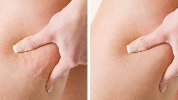 تجنبي الاستحمام بماء ساخن.. 10 طرق لإزالة السيلوليت