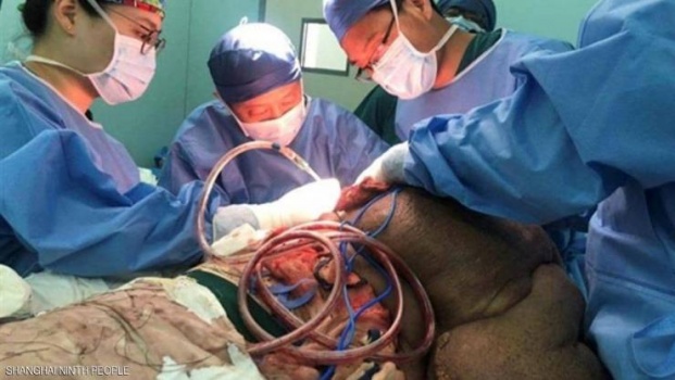 صور| 33 ساعة لإنقاذ رجل من ورم سرطاني وزنه 28 كيلوغراما