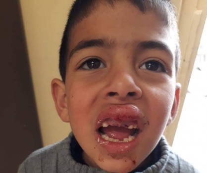 مستوطن يدهس طفل من الخليل ويصيبه بجراح