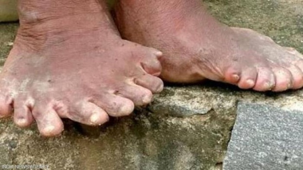 مأساة مرأة تملك 31 اصبعا!