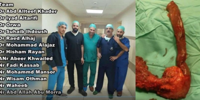 إستمرت 12ساعة..فريق طبي يجري عملية جراحية نادرة ومعقدة لاستئصال كامل البنكرياس والاثنى عشر