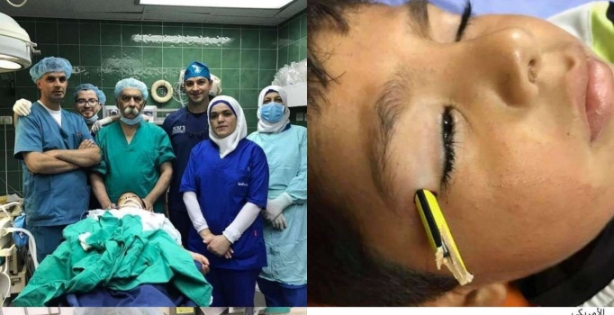 فريق طبي في مستشفى رفيديا ينجح بإزالة قلم من عين طالب