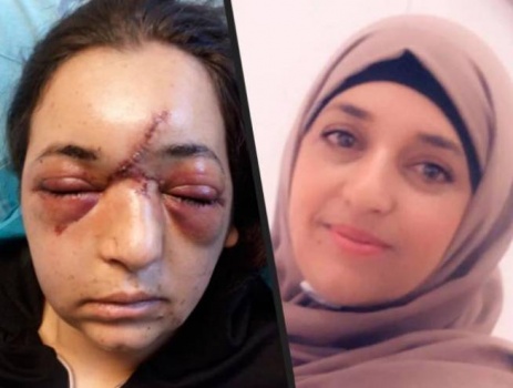 جندي يكسر جمجمة مقدسية حاولت حماية طفلها
