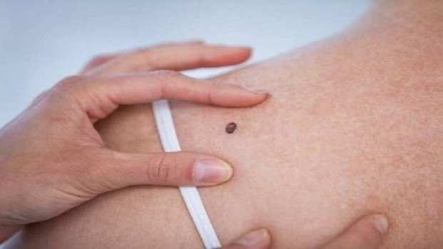 متى تصبح الشامة والنمش من أعراض سرطان الجلد؟