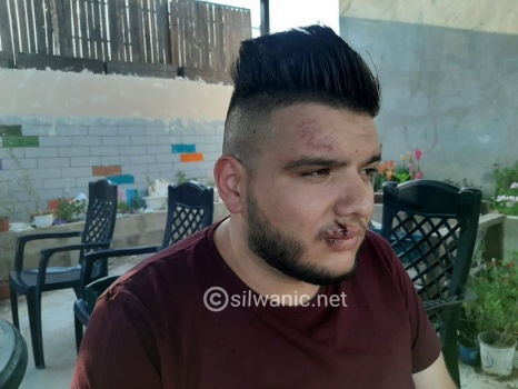 صور : مستوطن يطلق كلبه على سائق حافلة مقدسي !