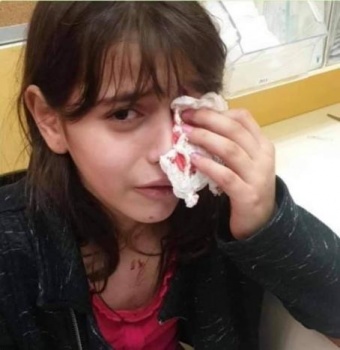 إصابة طفلة بعينها في هجوم للمستوطنين بالقدس المحتلة