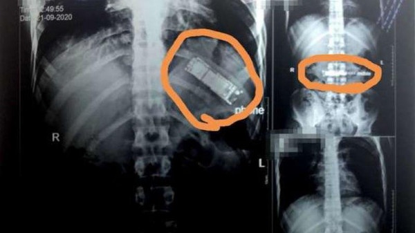 في وصلة مزاح.. شاب يبتلع هاتفاً محمولاً منذ 7 أشهر