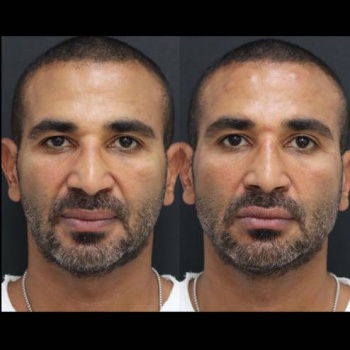 أحمد سعد يكشف سبب إجرائه جراحة تجميلية في وجهه