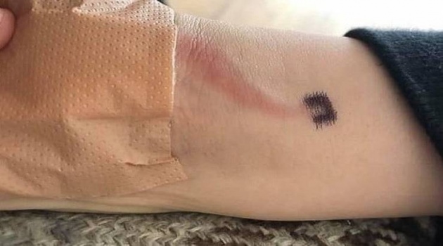 لهذا السبب يجب الانتباه لجروح الأطفال بعد سقوطهم