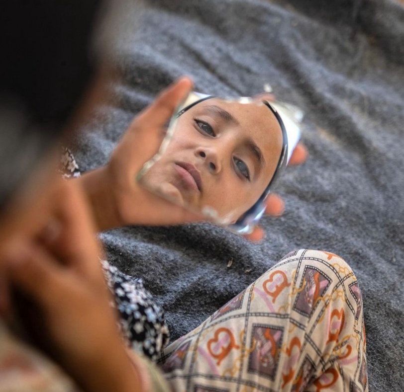سما بدون شعر.. طفلة جميلة ترى بعينيها آلام غزة وأوجاعها (صور)