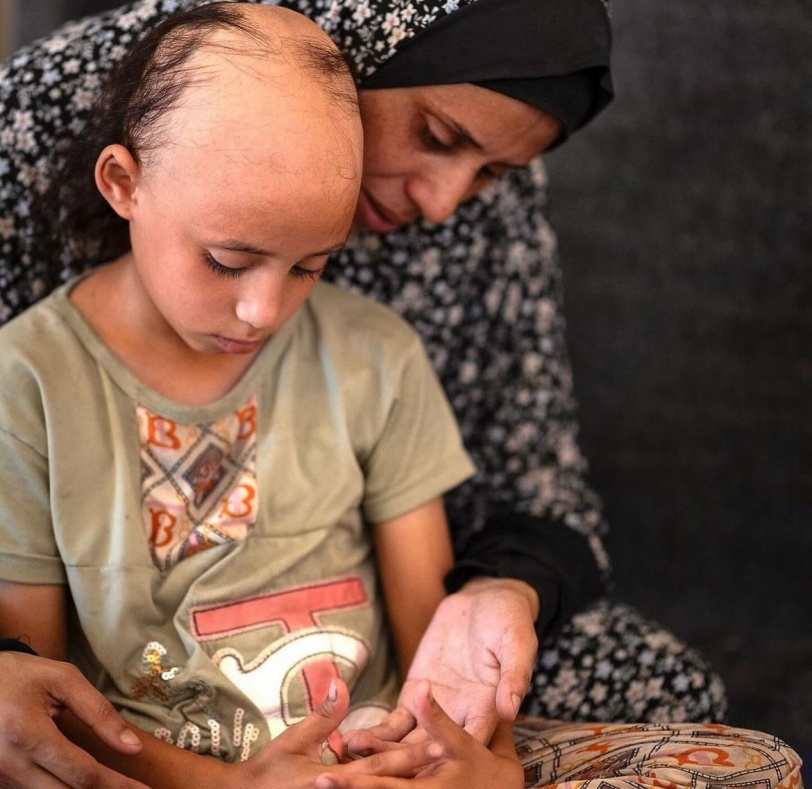 سما بدون شعر.. طفلة جميلة ترى بعينيها آلام غزة وأوجاعها (صور)
